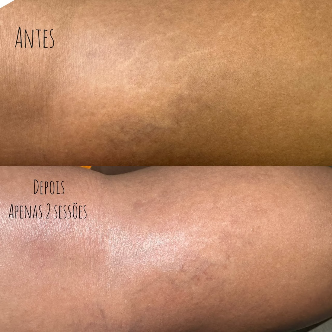 Antes e depois tratamento de estrias — Instituto Amabilia