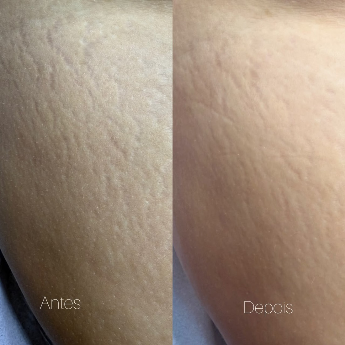 Antes e depois tratamento de estrias — Instituto Amabilia