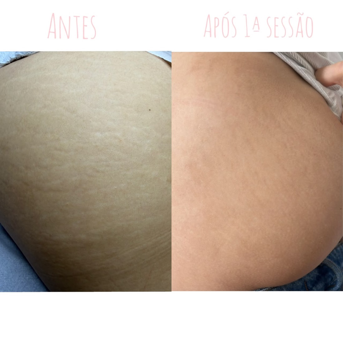 Antes e depois tratamento de estrias — Instituto Amabilia