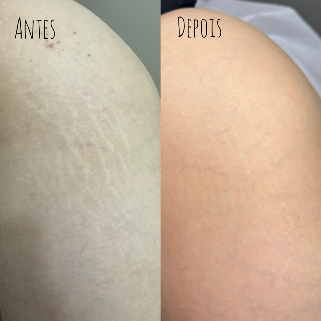 Antes e depois tratamento de estrias — Instituto Amabilia