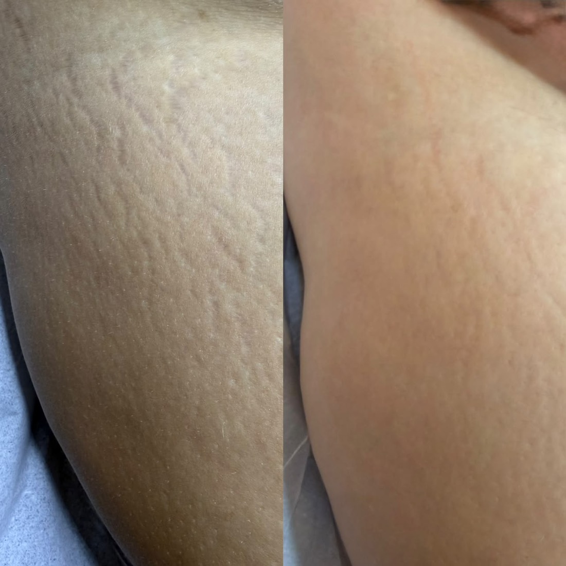 Antes e depois tratamento de estrias — Instituto Amabilia
